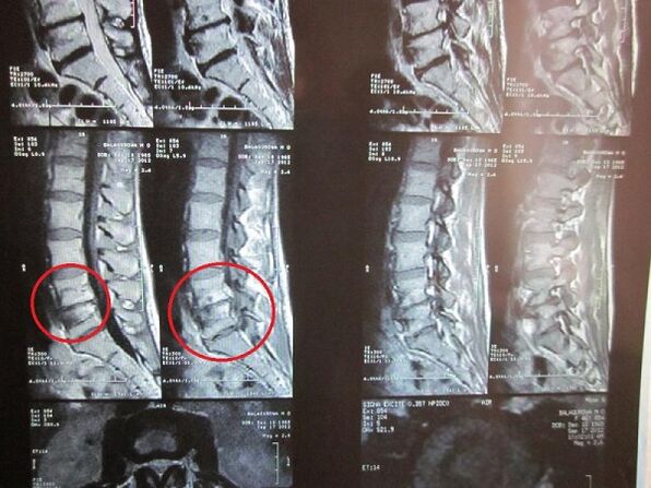 Діагностика шийного остеохондрозу