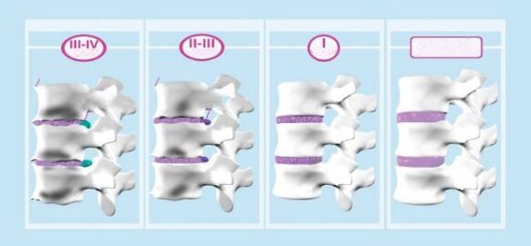 Етапи шийного остеохондрозу