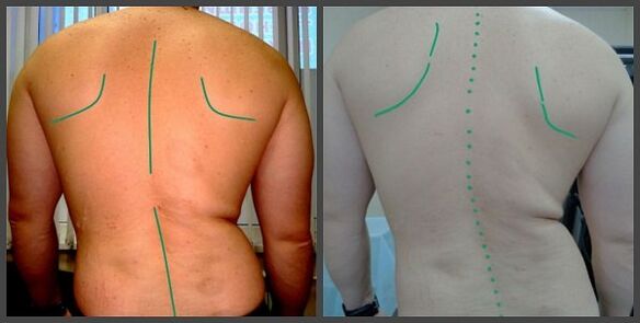 Кривизна хребта з остеохондросом