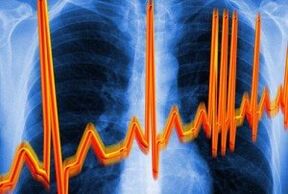 Серце Аритмія для остеохондрозу