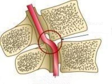 Синдром Вейла Артерії