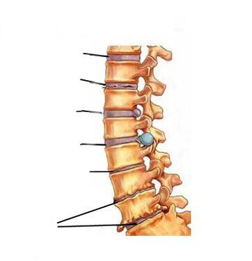 Як розвивається остехондроз