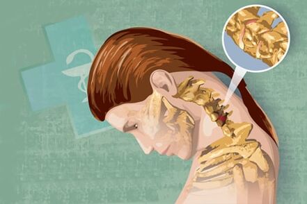 Рефлекторні симптоми остеохондрозу